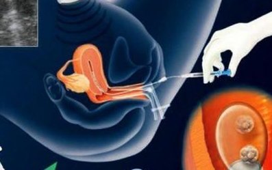 巧克力囊肿做试管有没有影响多少钱？